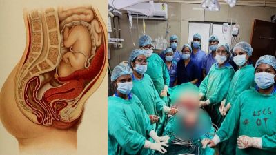 छत्तीसगढ़ का पहला मामला : मेकाहारा में दुर्लभ प्रेग्नेंसी का सफल ऑपरेशन, गर्भाशय में नहीं पेट में पला भ्रूण, मां और शिशु दोनों सुरक्षित